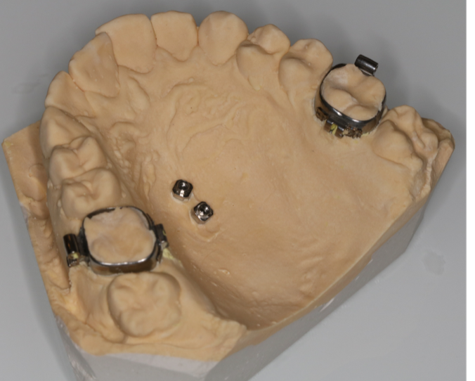 model z analogami i pierścieniami